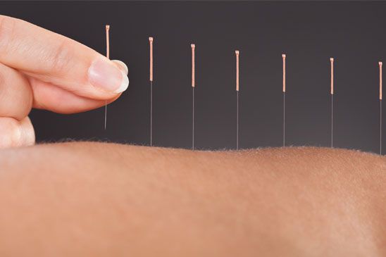Community acupuncture treatment